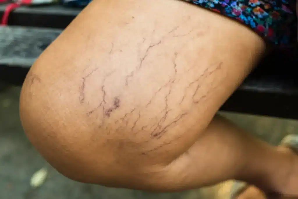 Sclerotherapy for spider vein removal